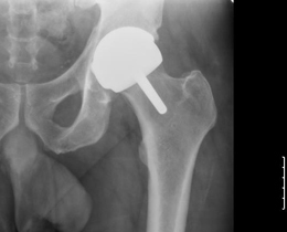 X-Ray Hip Resurfacing